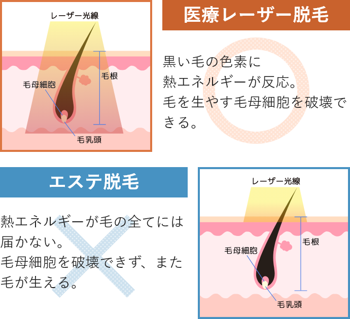 医療脱毛とエステ脱毛の違い